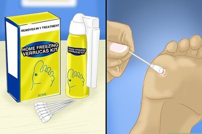 How to Remove Verrucas