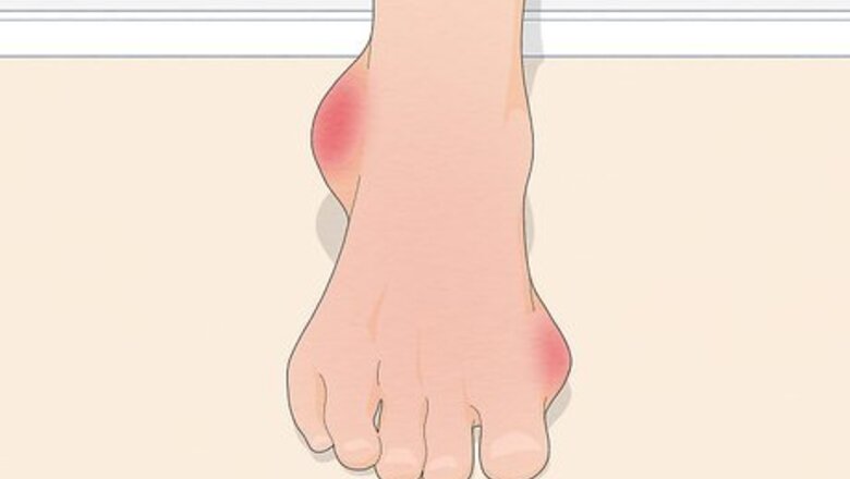 How to Treat Gout