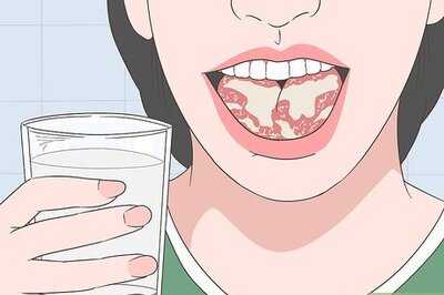 How to Treat Geographic Tongue