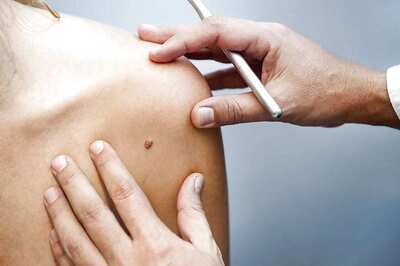 Melanoma Patients Who Remove Lymph Nodes Don't Live Longer