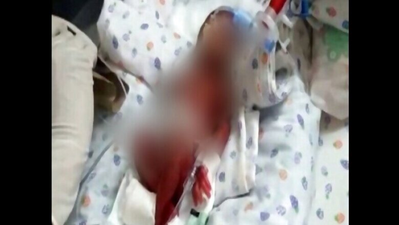 Delhi Hospital Returns 'Dead Twins' in Plastic Bags to Parents, One Found Alive