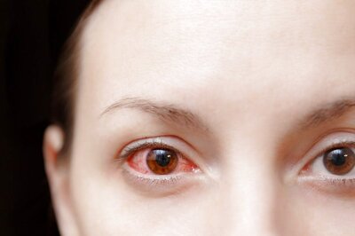 Surge in Hepatitis A and E, Eye Flu Cases Following Unusual Rains in NCR