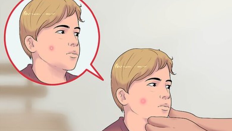 How to Recognize Rocky Mountain Spotted Fever Symptoms
