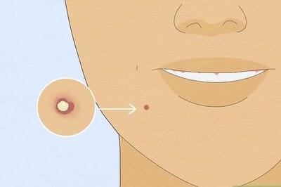 How to Get Rid of Pimples with Baking Soda