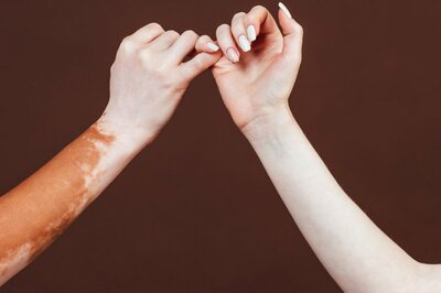 International Albinism Awareness Day 2022: Theme, History and Significance