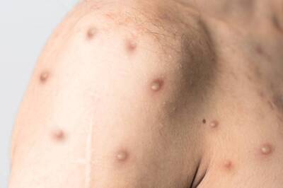 States Told to Ensure Screening, Testing of All Suspect Monkeypox Cases at Points of Entry