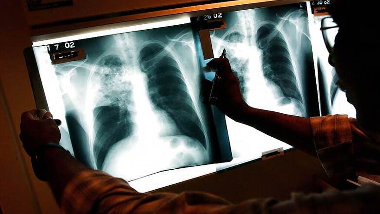 How the Govt Went Door to Door to Hunt Down Tuberculosis