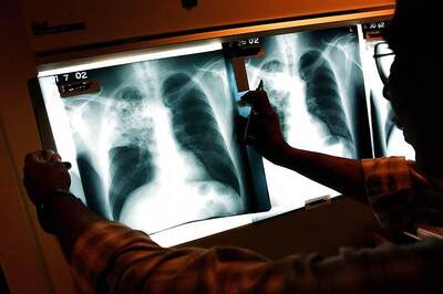 How the Govt Went Door to Door to Hunt Down Tuberculosis