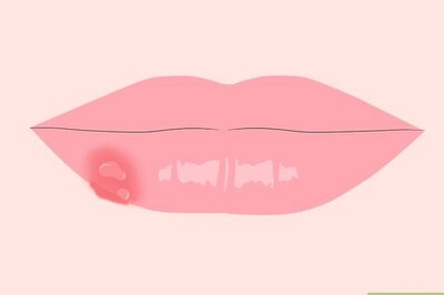 How to Get Rid of Mouth Blisters