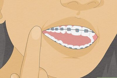 How to Temporarily Fix a Loose Wire on Your Braces