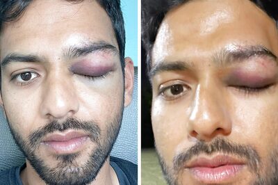 'It's Never A Smooth Ride for An Athlete'- Under-19 World Cup Winner Unmukt Chand's Bruised Picture Breaks the Internet
