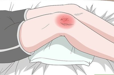 How to Heal a Bruised Knee