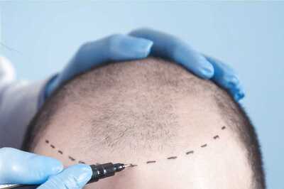 Hair Transplantation: All you Need to Know