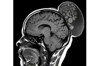 'Sack of Marbles' Growing on Bengaluru Woman's Scalp Since Childhood Removed | All About Cystic Teratoma