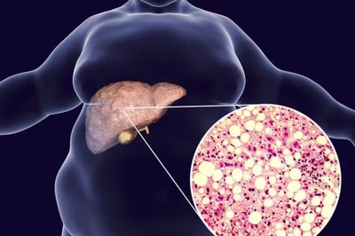 Lemon To Turmeric, Foods That Can Help Combat Fatty Liver Disease