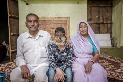 17-year-old Teen In Madhya Pradesh Suffers From Hypertrichosis, A Rare Werewolf Syndrome
