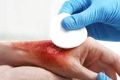 What Are Burn Injuries? Know Treatments For Patients