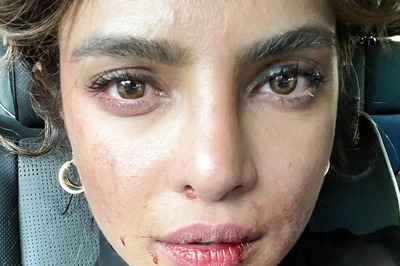 Priyanka Chopra's Face Covered in Bruises on Sets of Citadel, She Calls It 'Tough Day at Work'