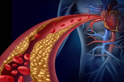 What Is Inclisiran, Touted To Be A Game Changer In Cholesterol Management