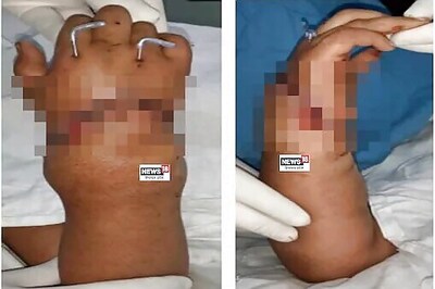 Doctors Rejoin Eight-Year-Old’s Severed Hand At PGIMER Chandigarh