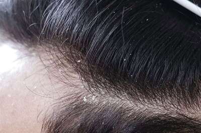 Hair Loss To Lack Of Energy? Know Common Signs Of Vitamins and Minerals Deficiency