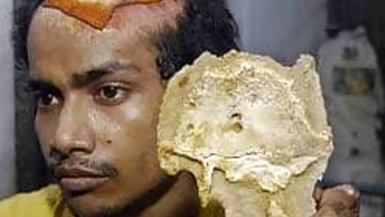 Piece of man’s skull falls off, draws crowd