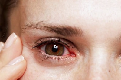 Conjunctivitis Cases Rise During Monsoons: Protect Your Eyes Now