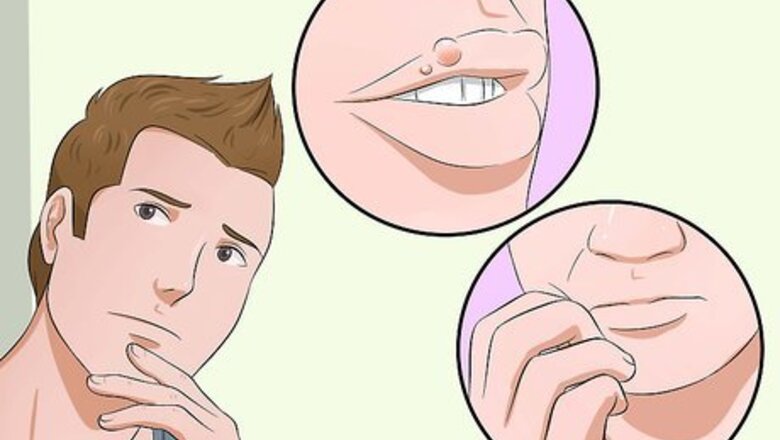 How to Heal Cold Sores