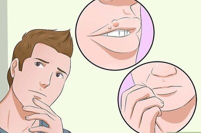 How to Heal Cold Sores