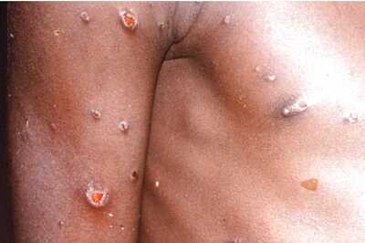 WHO to Probe if Rising Monkeypox Outbreak can be Declared Global Emergency