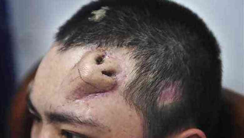 Chinese surgeon builds new nose on man's forehead