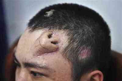 Chinese surgeon builds new nose on man's forehead