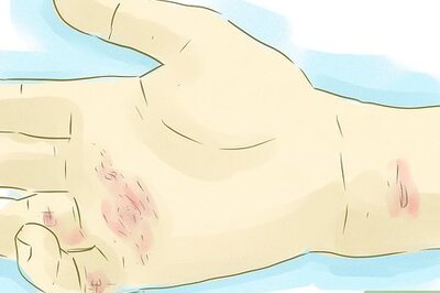 How to Live with Ehlers Danlos Classical Type